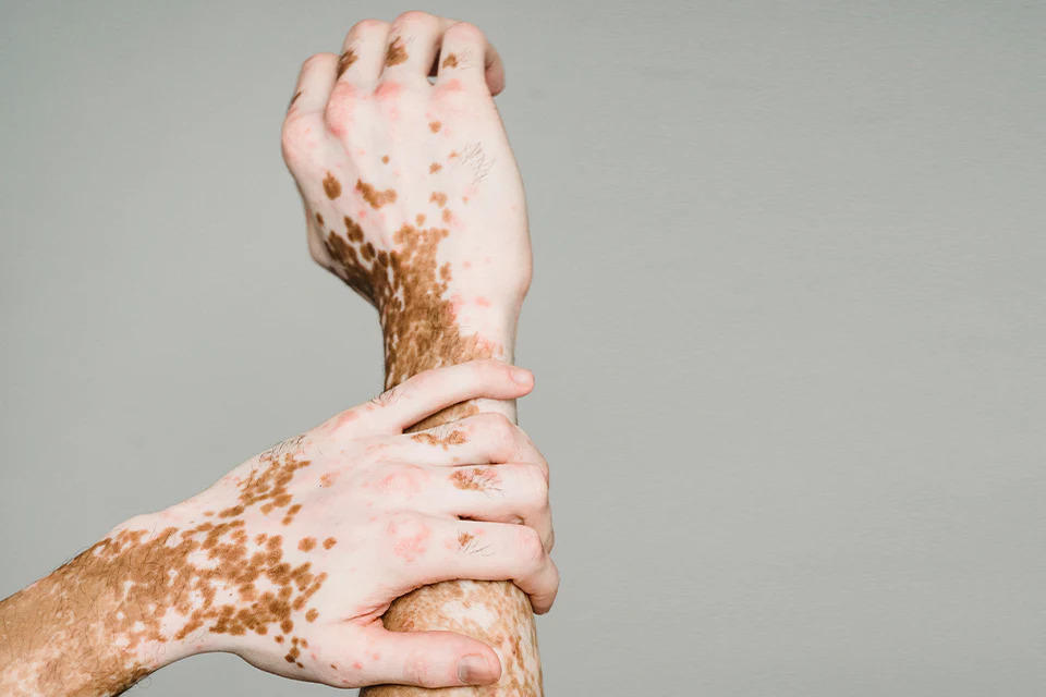 Vitiligo Treatment in Kerala – What Works, What Doesn’t, and What’s Next