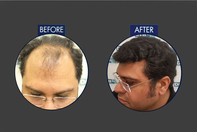Hair Transplant in Delhi