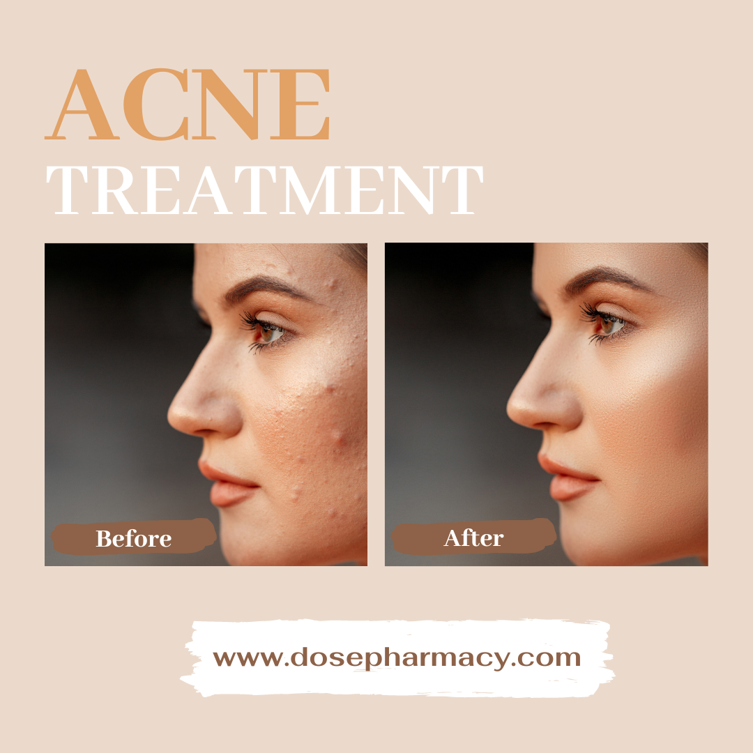 Accutane 40mg: Genuine Acne Cure - Dosepharmacy