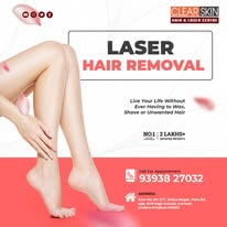 Laser Treatment For Birthmark Removal In India