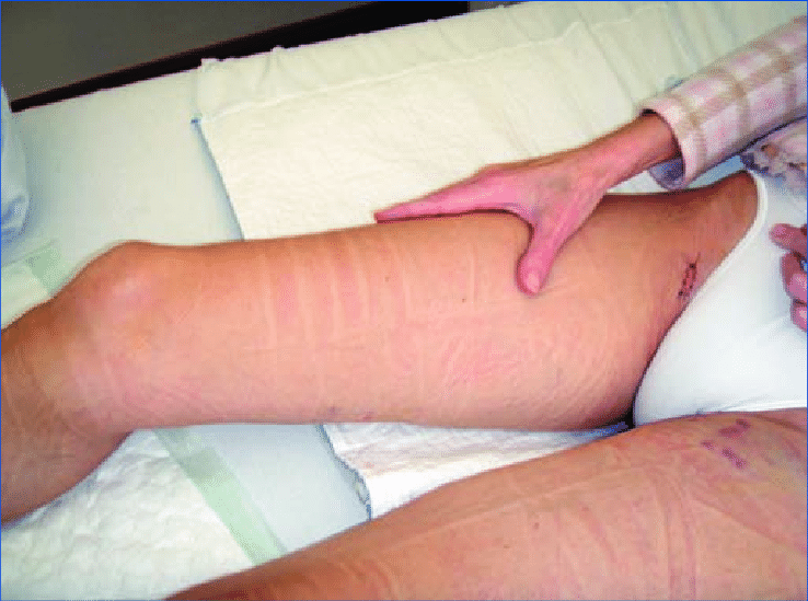 Lindenhurst Varicose Vein Treatment Near Me