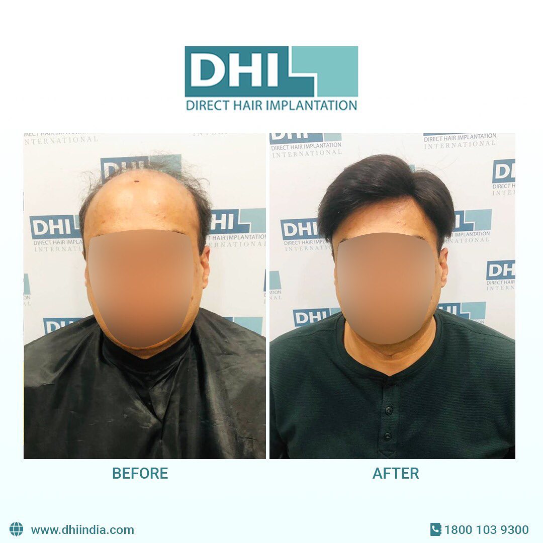 Is Your Hair Loss Making You Lack Confidence And Building Societal Pressure Upon You?