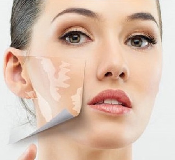 Get Vitiligo Treatment After Detailed Skin Evaluation