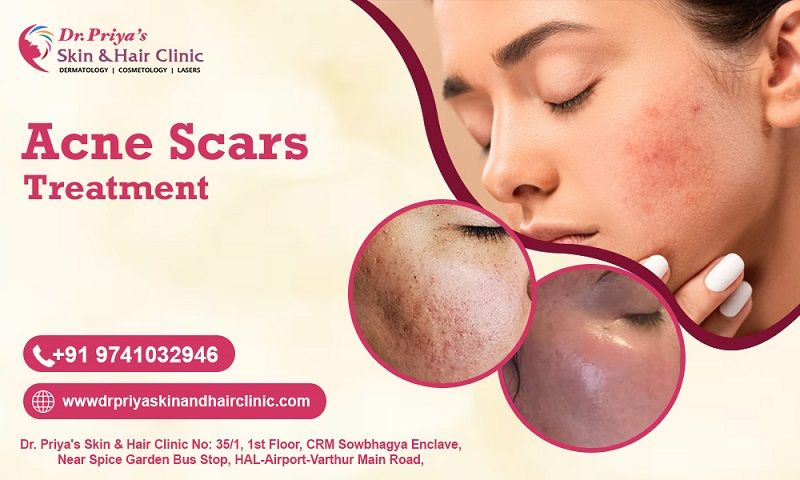 Advanced Acne Scar Removal Solutions in Bangalore - Dr. Priya Skin and Hair Clinic